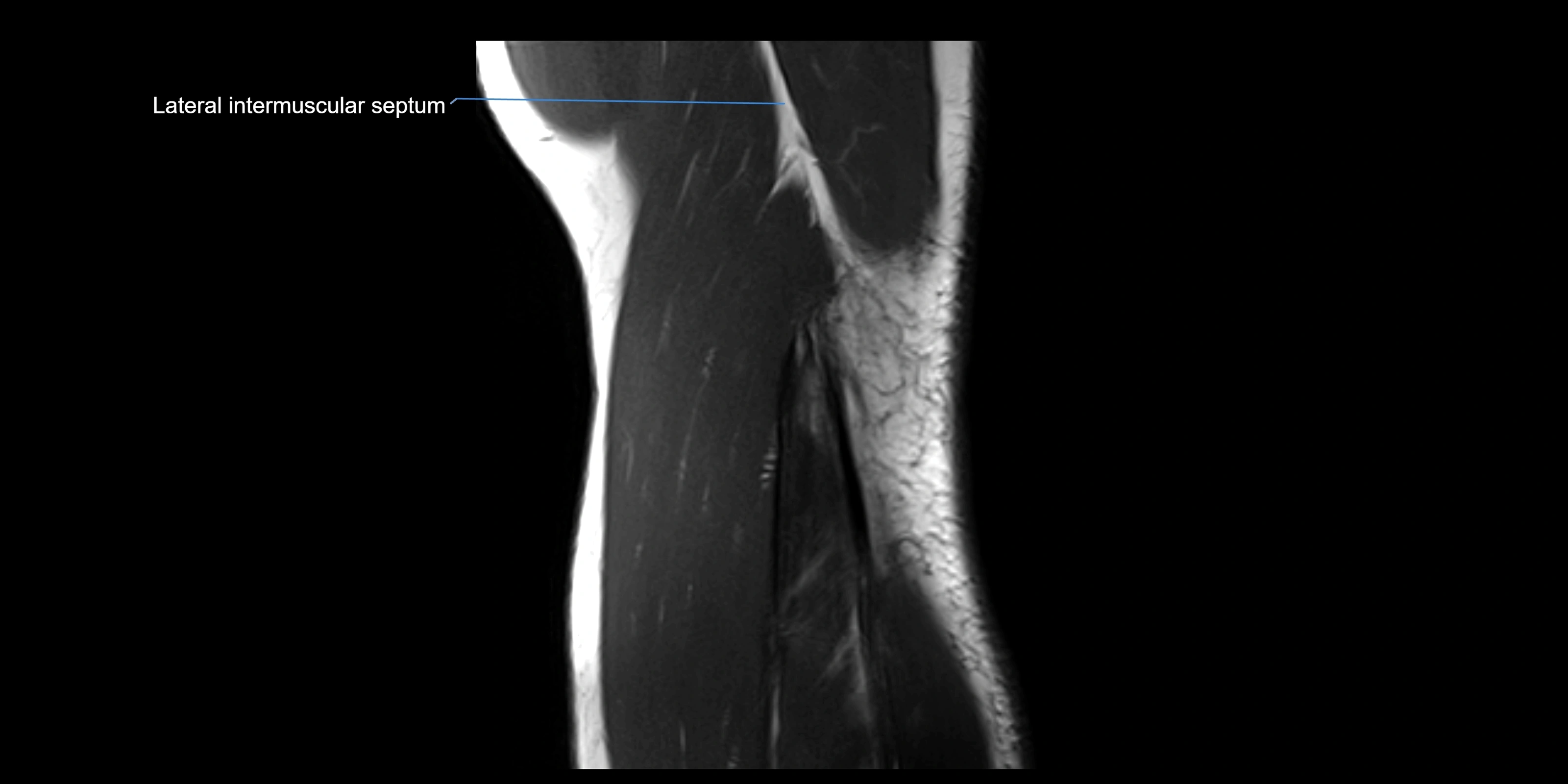 MRI elbow sagittal cross sectional anatomy 3T radiology  image-img-00001-00021.webp